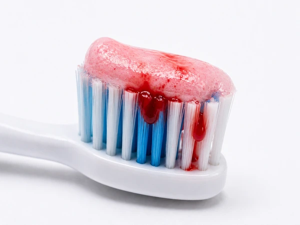 Common Causes of Bleeding Gums